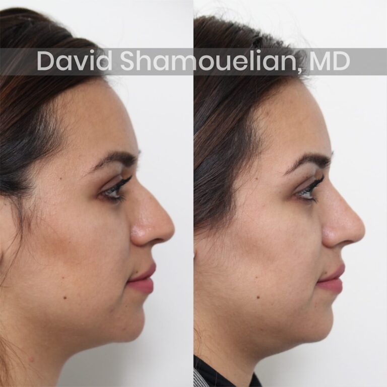 allure-bh-before-after-patient-3-image-2