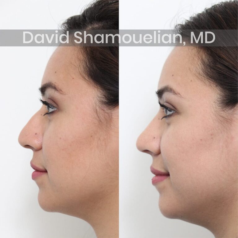 allure-bh-before-after-patient-3-image-3