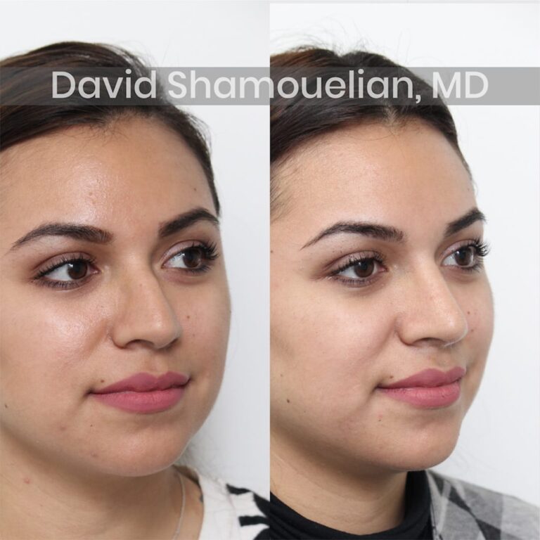 allure-bh-before-after-patient-3-image-4