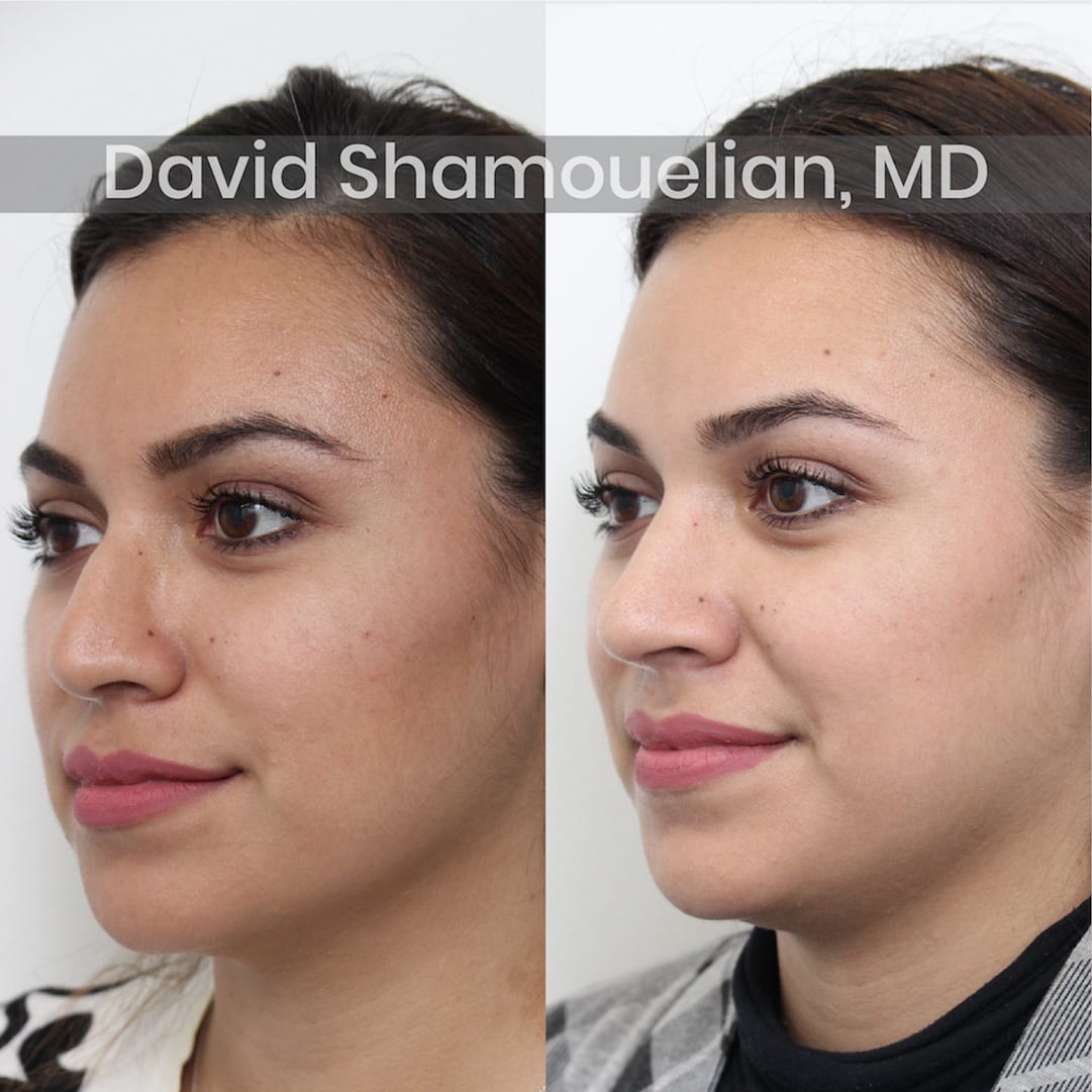 allure-bh-before-after-patient-3-image-5