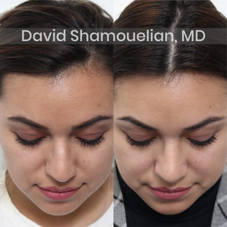allure-bh-before-after-patient-3-image-6