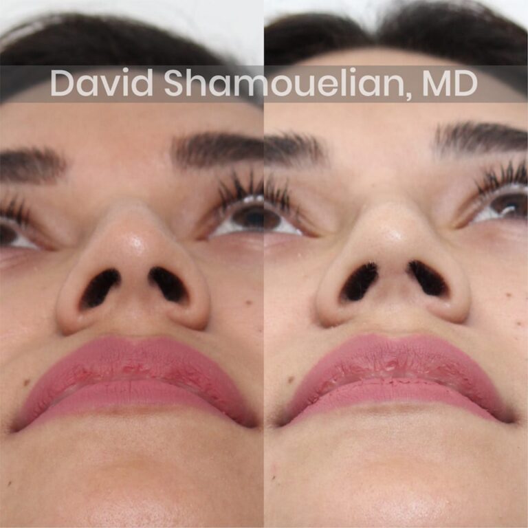 allure-bh-before-after-patient-3-image-7