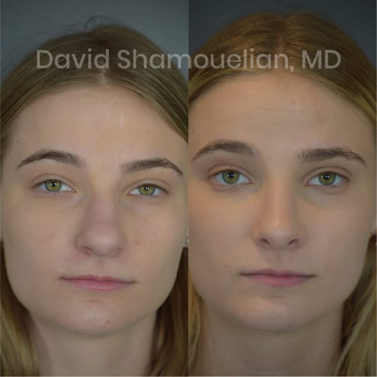 allure-bh-before-after-posts-pt-10-13-01