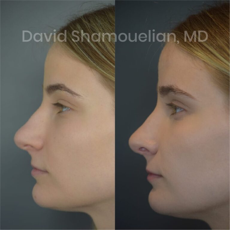 allure-bh-before-after-posts-pt-10-13-02