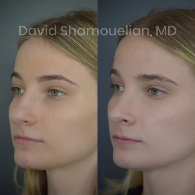allure-bh-before-after-posts-pt-10-13-03