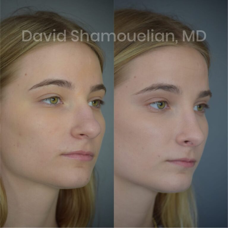 allure-bh-before-after-posts-pt-10-13-04