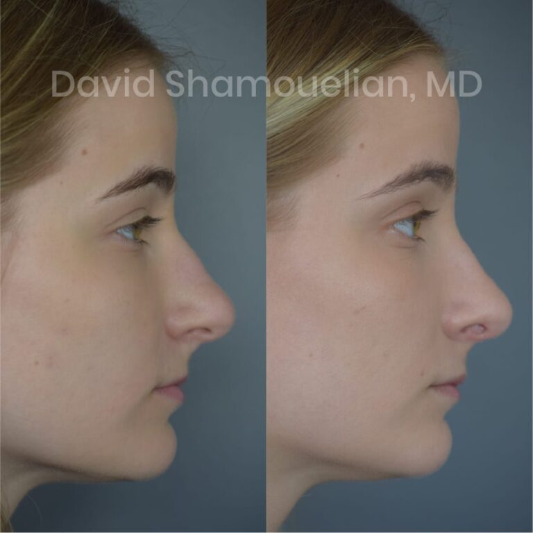 allure-bh-before-after-posts-pt-10-13-05