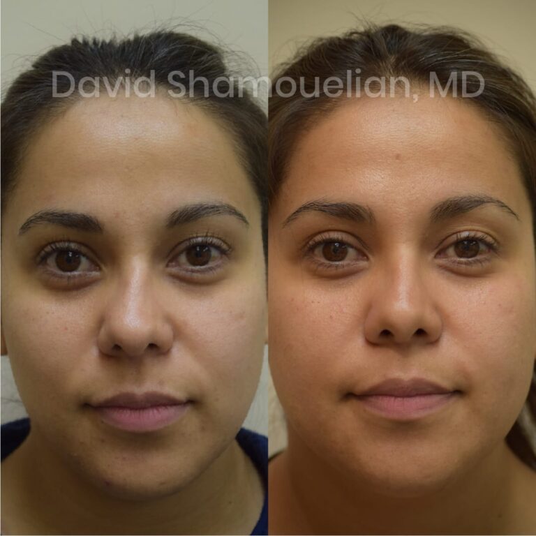 allure-bh-before-after-posts-pt-10-13-15