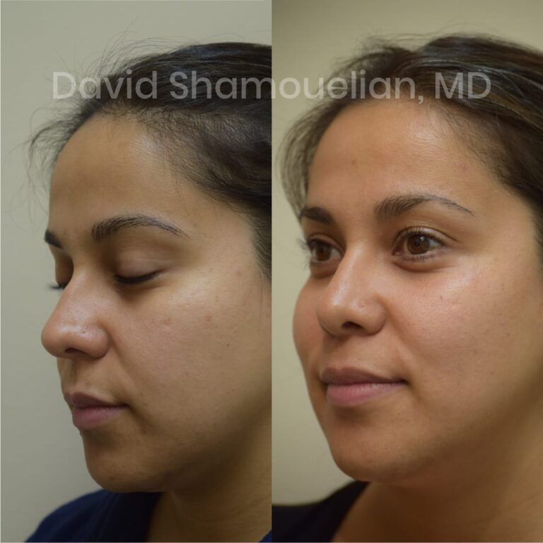 allure-bh-before-after-posts-pt-10-13-16