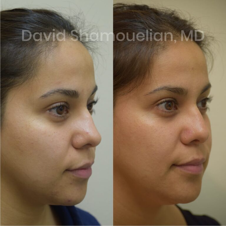 allure-bh-before-after-posts-pt-10-13-17