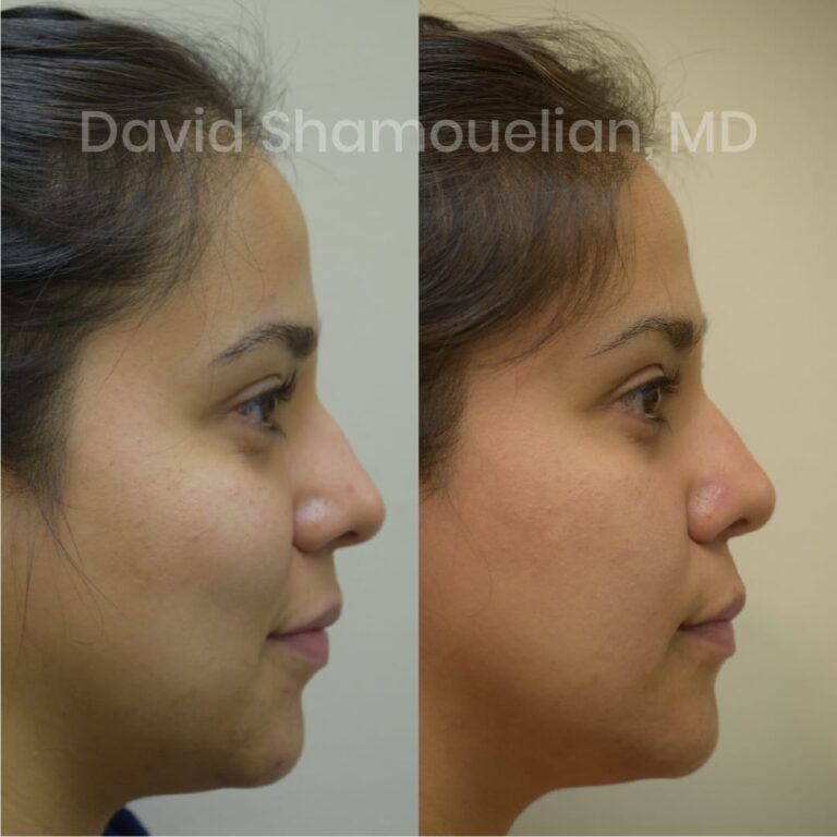 allure-bh-before-after-posts-pt-10-13-18