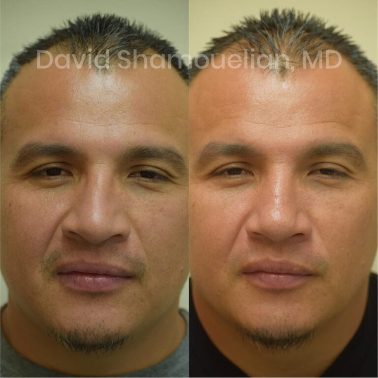 allure-bh-before-after-posts-pt-14-01