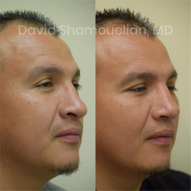 allure-bh-before-after-posts-pt-14-02