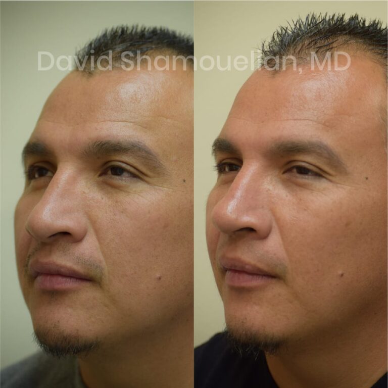 allure-bh-before-after-posts-pt-14-04