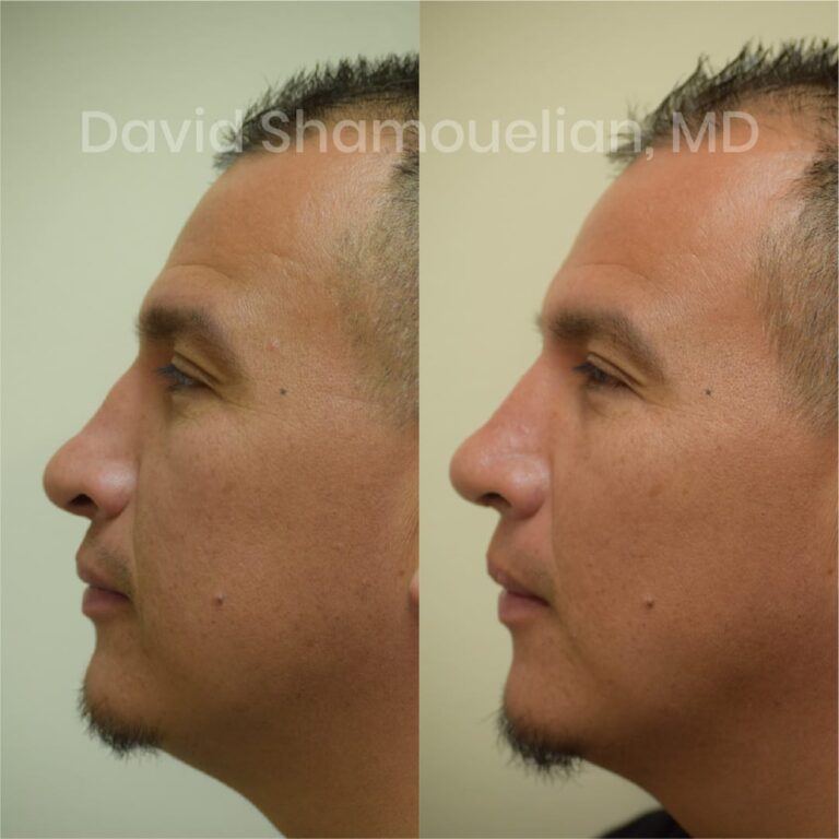 allure-bh-before-after-posts-pt-14-05