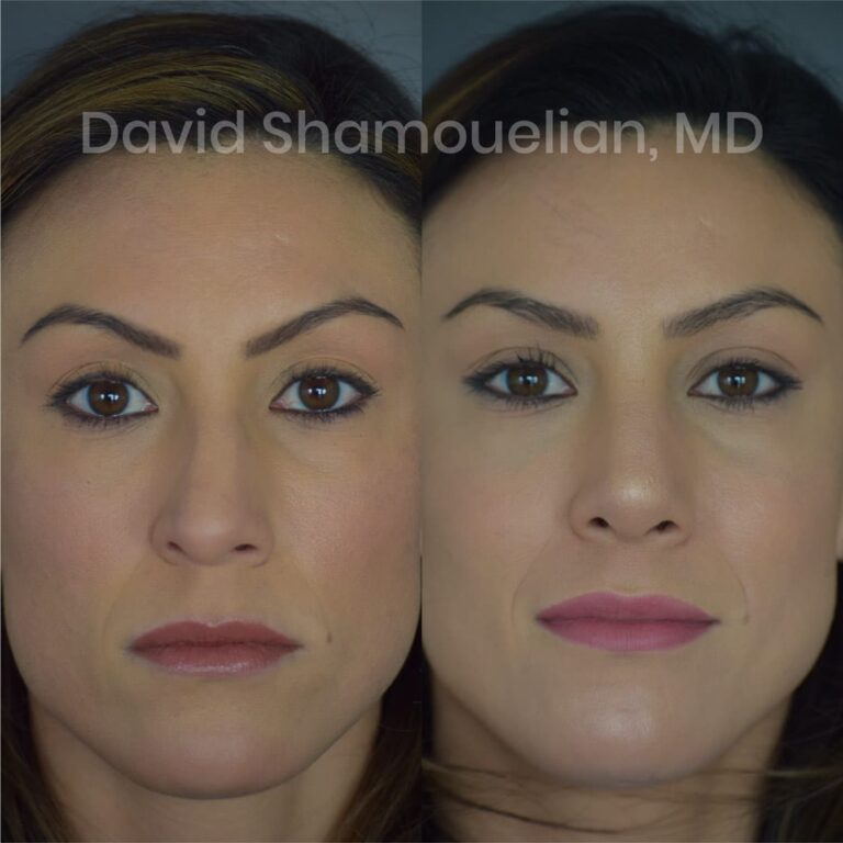 allure-bh-before-after-posts-pt-15-01