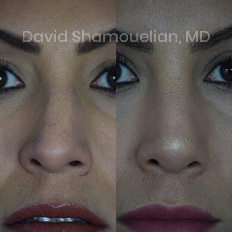 allure-bh-before-after-posts-pt-15-04