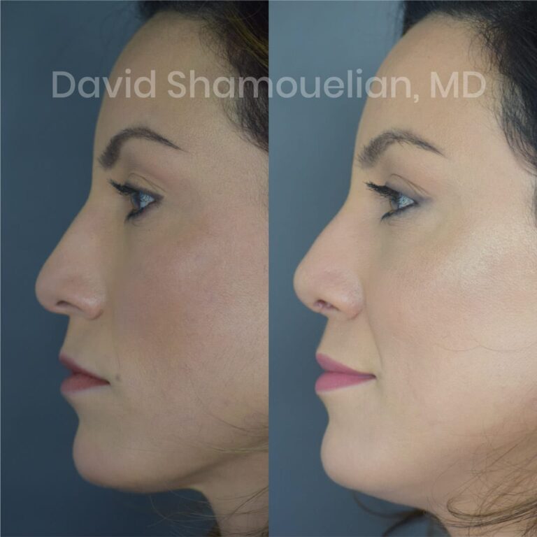 allure-bh-before-after-posts-pt-15-08