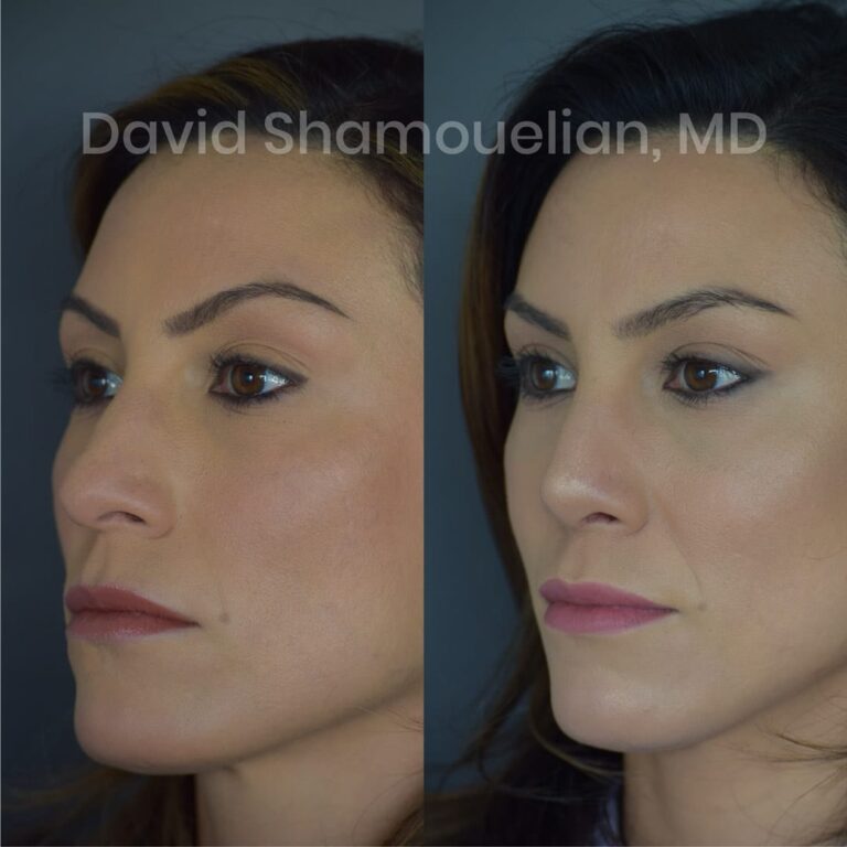 allure-bh-before-after-posts-pt-15-09