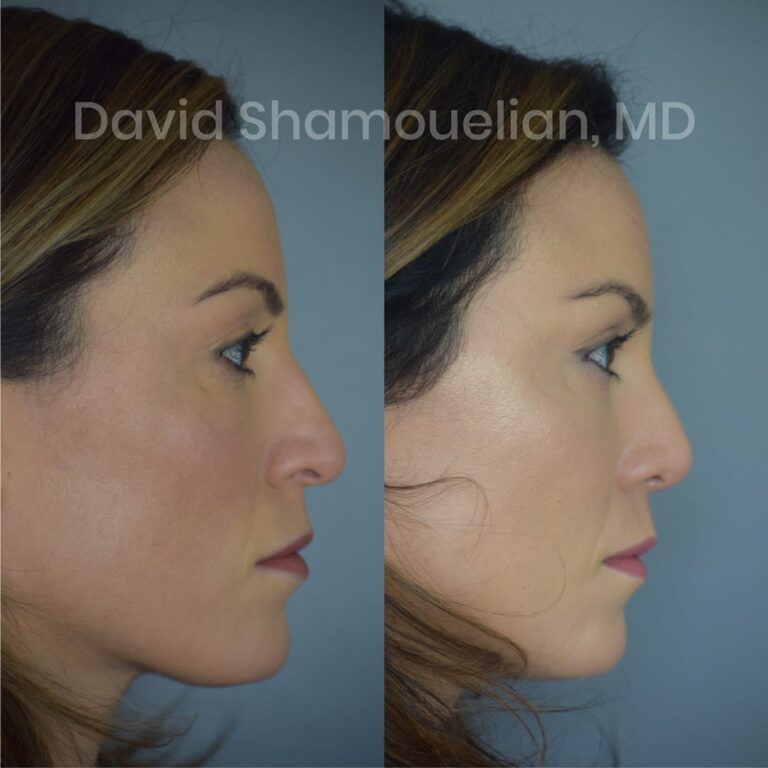 allure-bh-before-after-posts-pt-15-10
