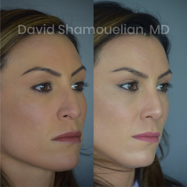 allure-bh-before-after-posts-pt-15-11