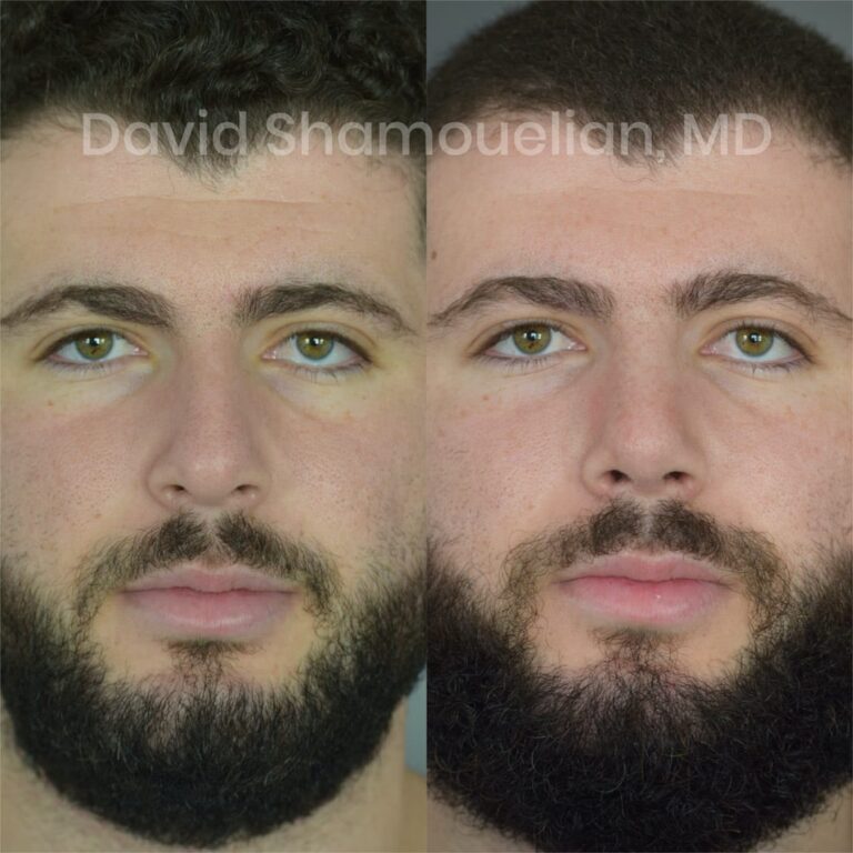 allure-bh-before-after-posts-pt-16-01