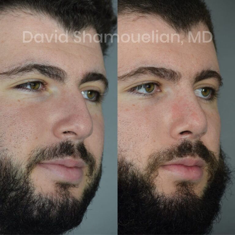 allure-bh-before-after-posts-pt-16-02