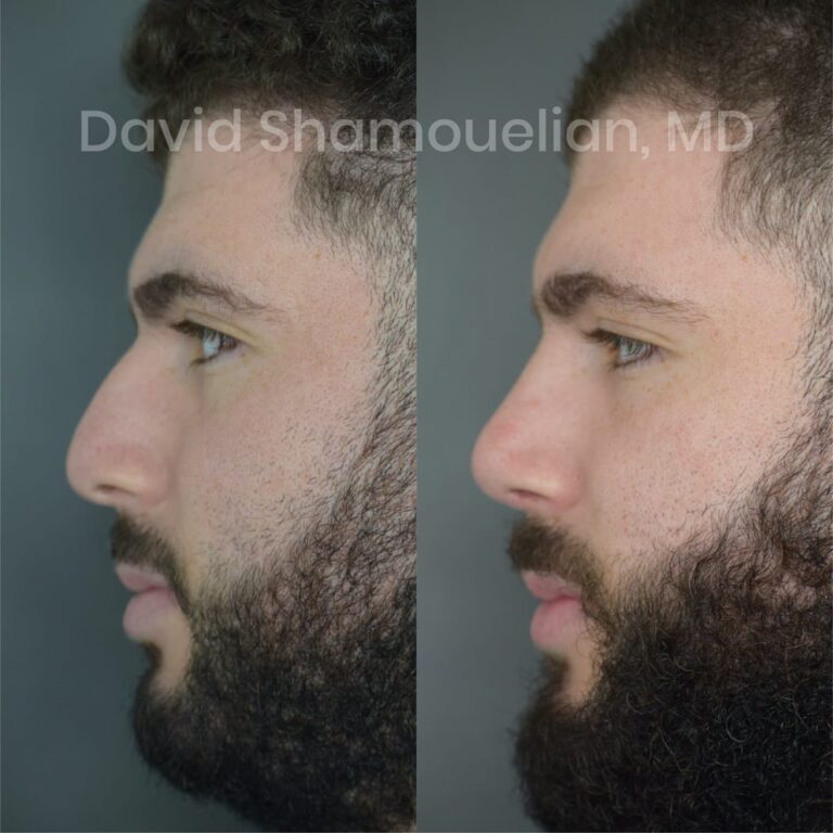 allure-bh-before-after-posts-pt-16-03