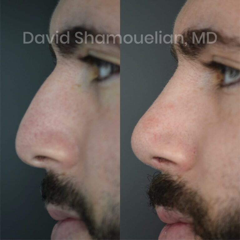 allure-bh-before-after-posts-pt-16-04