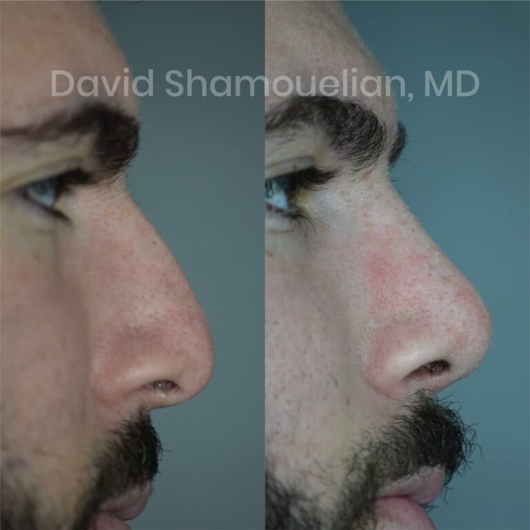 allure-bh-before-after-posts-pt-16-06