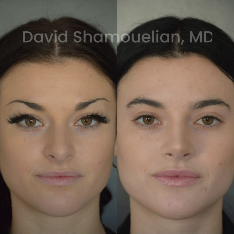 allure-bh-before-after-posts-pt-24-01