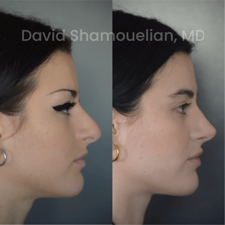 allure-bh-before-after-posts-pt-24-02
