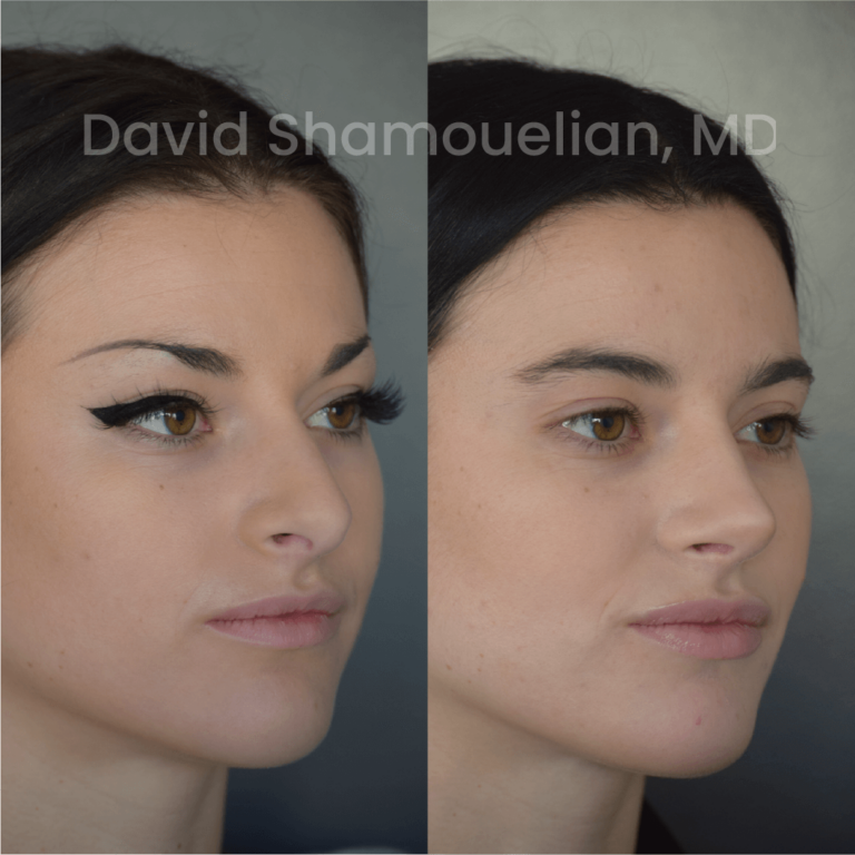 allure-bh-before-after-posts-pt-24-03