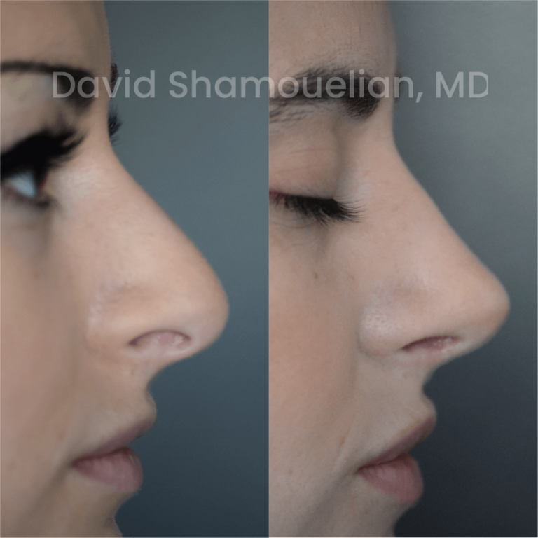 allure-bh-before-after-posts-pt-24-04