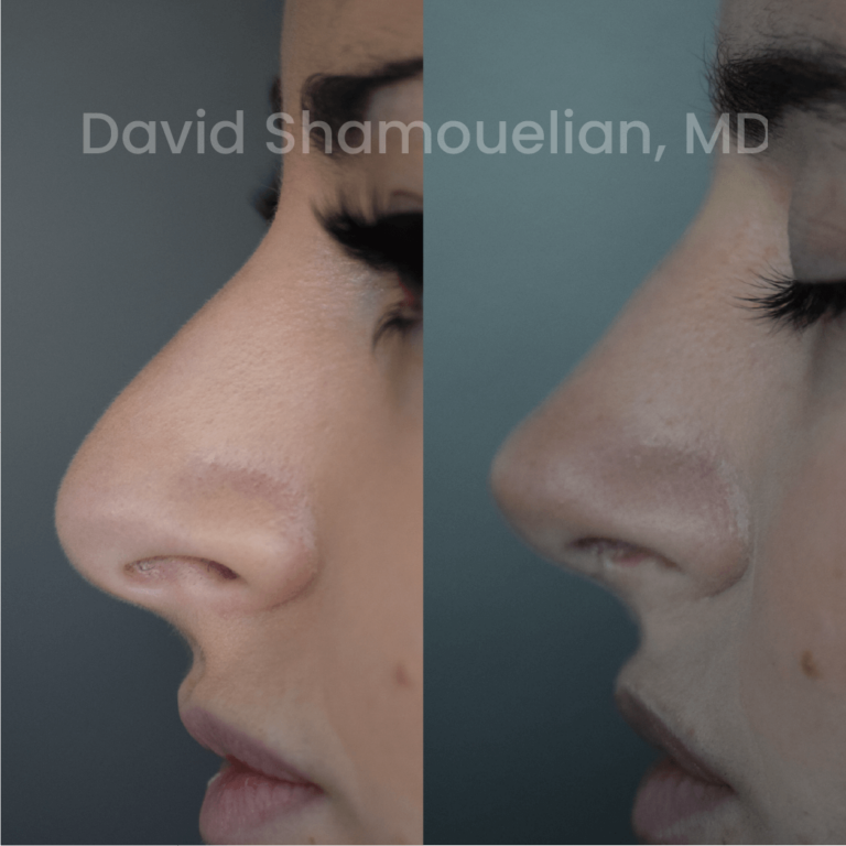 allure-bh-before-after-posts-pt-24-05