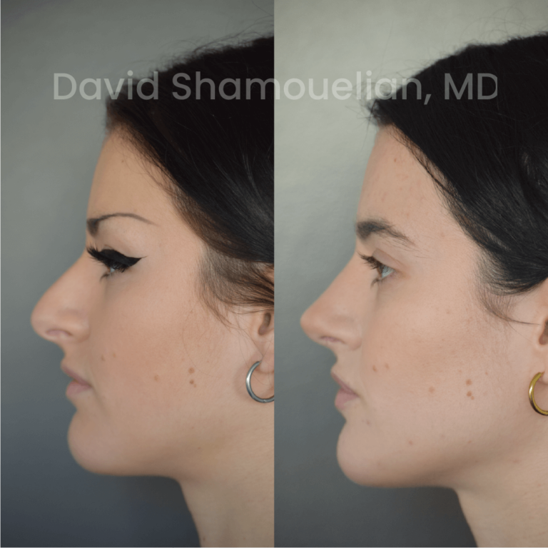 allure-bh-before-after-posts-pt-24-08