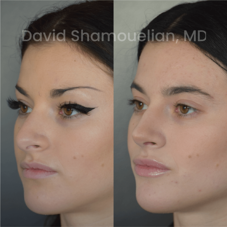 allure-bh-before-after-posts-pt-24-09