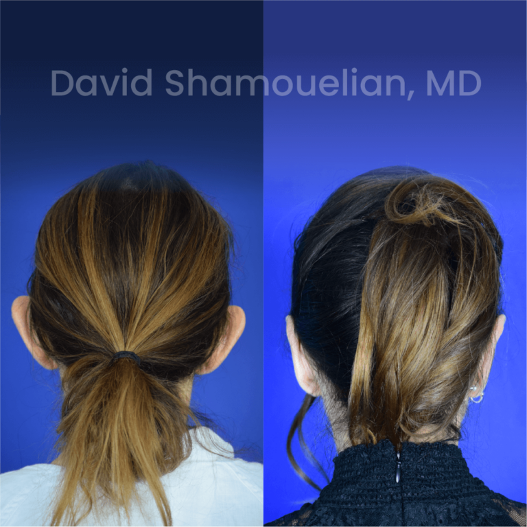 allure-bh-before-after-posts-pt-34-02