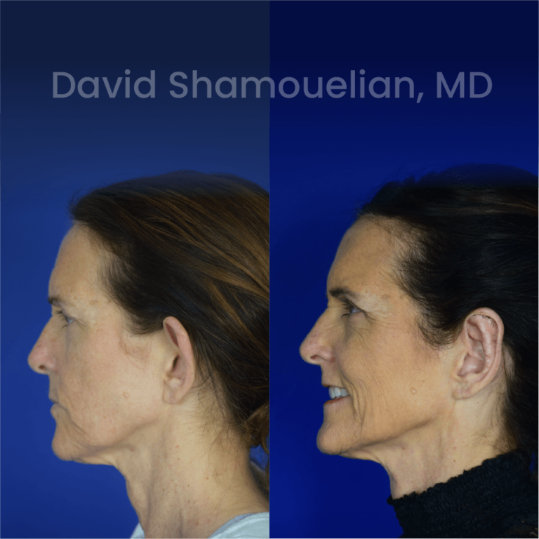 allure-bh-before-after-posts-pt-34-03