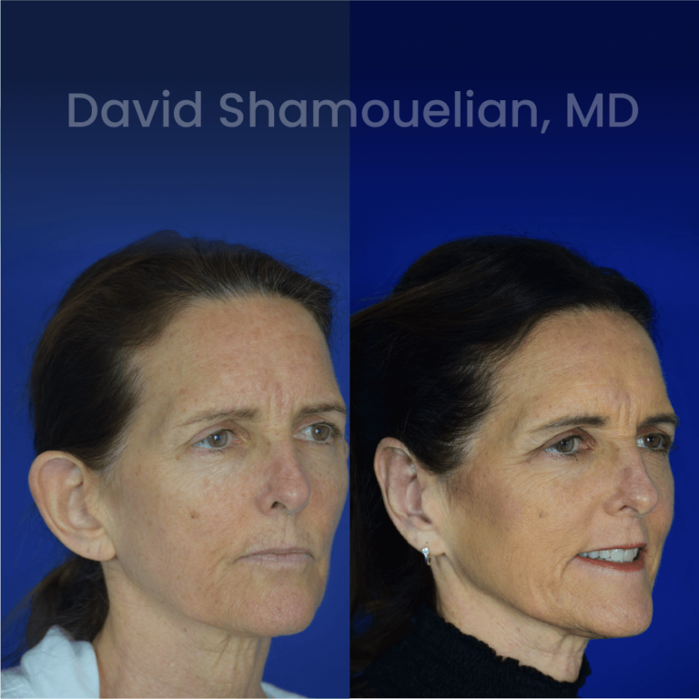 allure-bh-before-after-posts-pt-34-04
