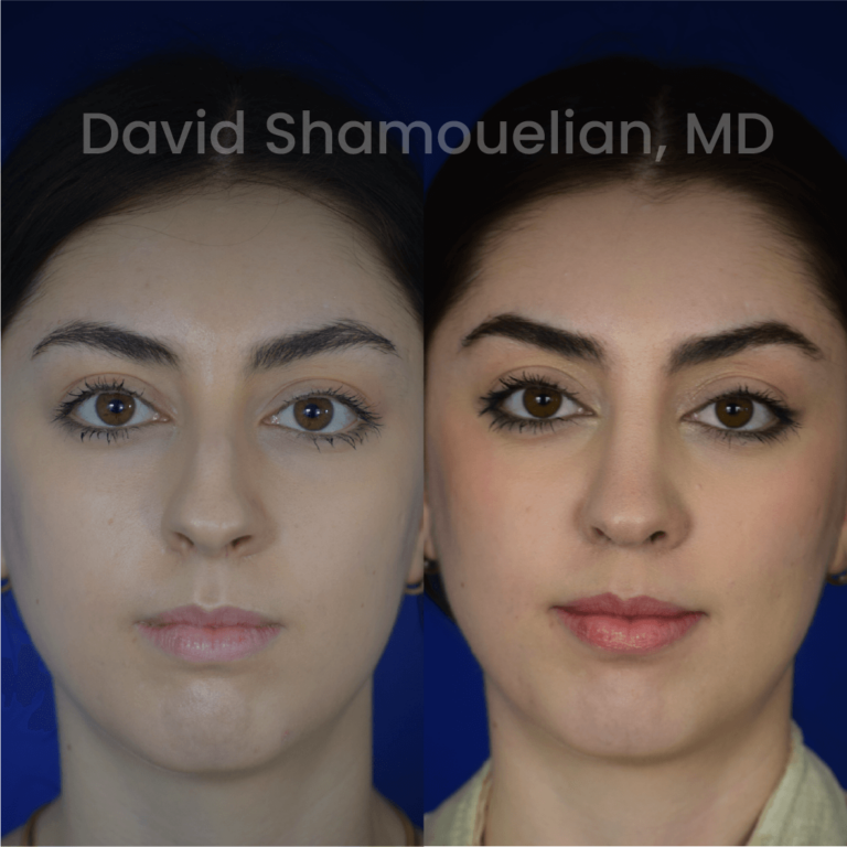 allure-bh-before-after-posts-pt-35-01