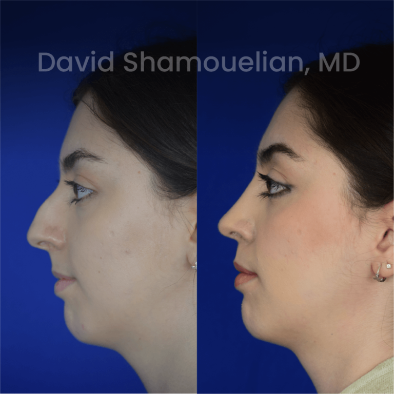 allure-bh-before-after-posts-pt-35-02