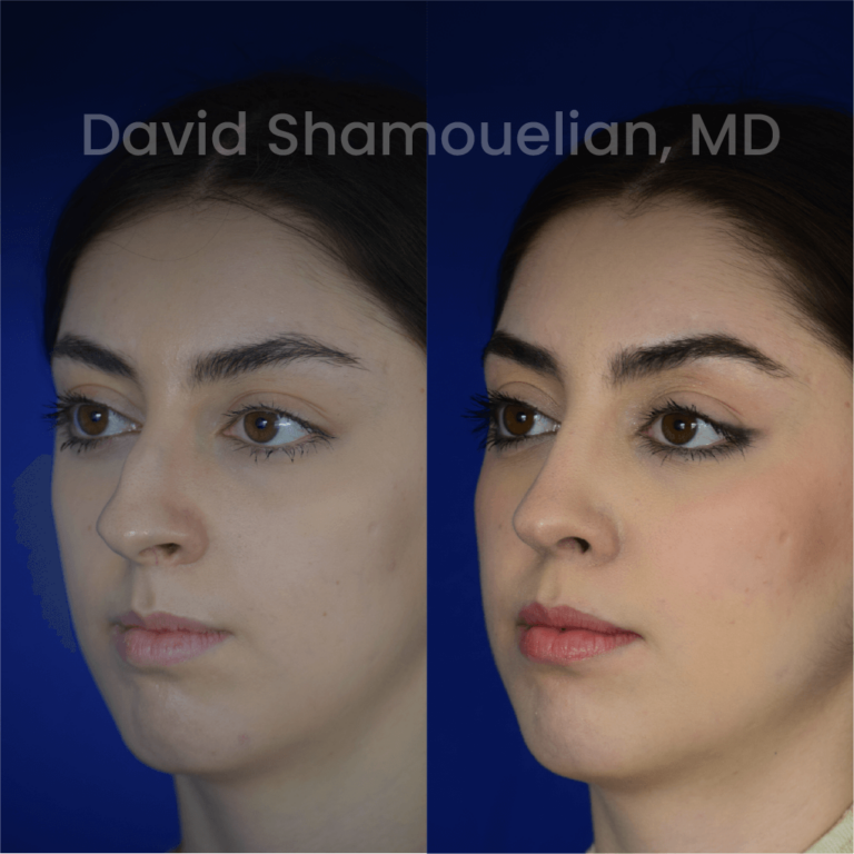 allure-bh-before-after-posts-pt-35-03