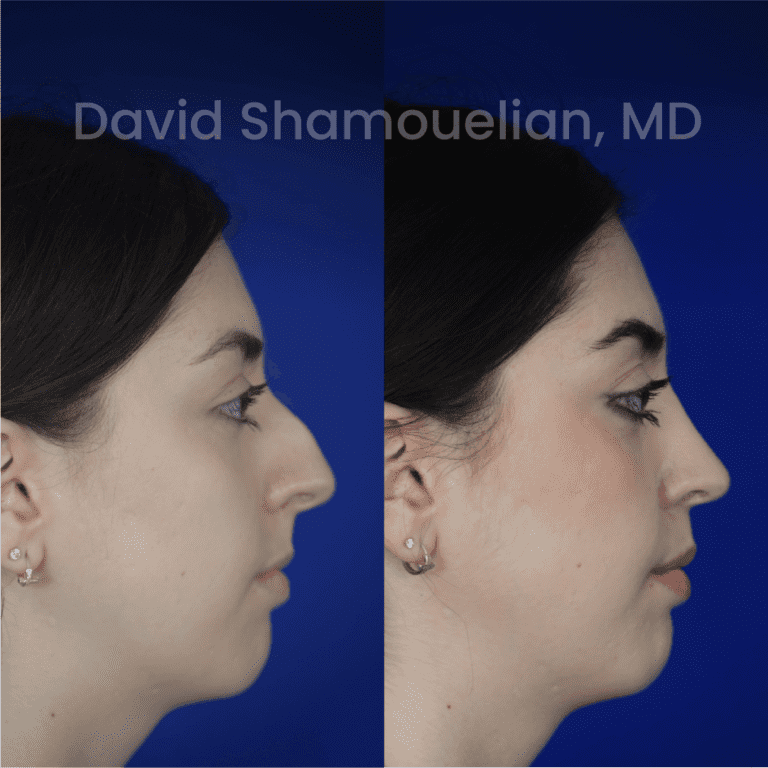 allure-bh-before-after-posts-pt-35-04