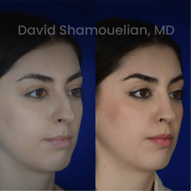 allure-bh-before-after-posts-pt-35-05