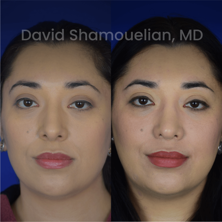 allure-bh-before-after-posts-pt-37-01