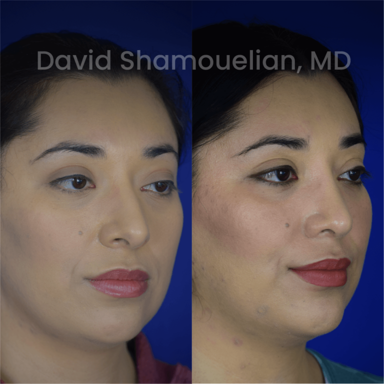 allure-bh-before-after-posts-pt-37-02