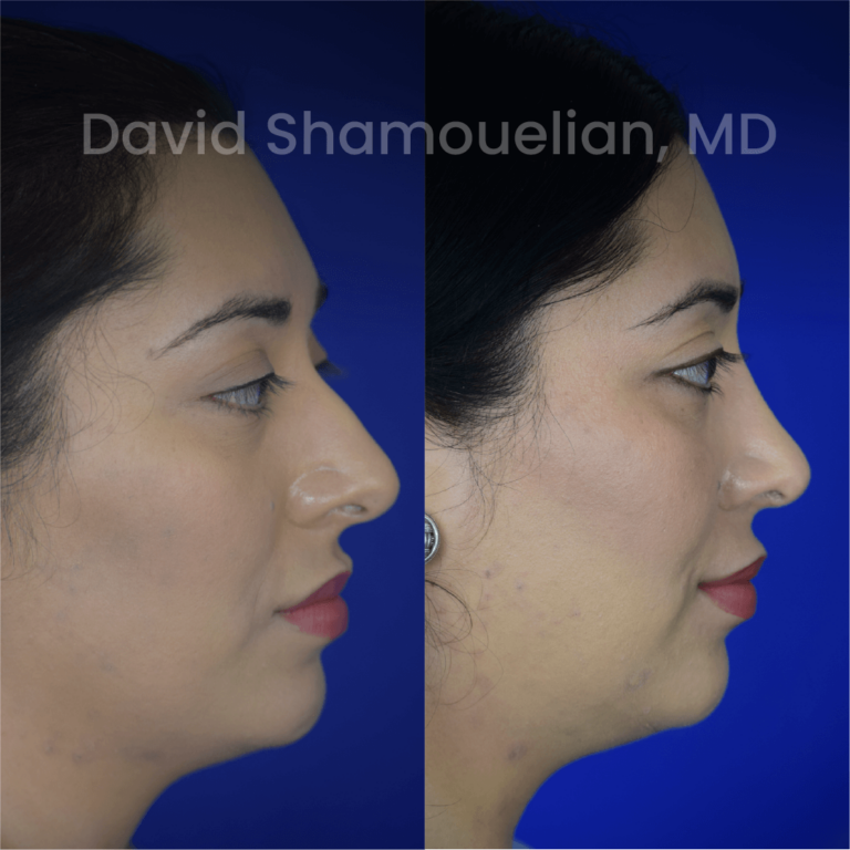 allure-bh-before-after-posts-pt-37-03
