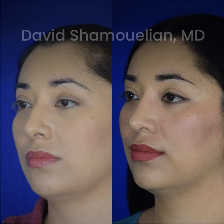 allure-bh-before-after-posts-pt-37-04