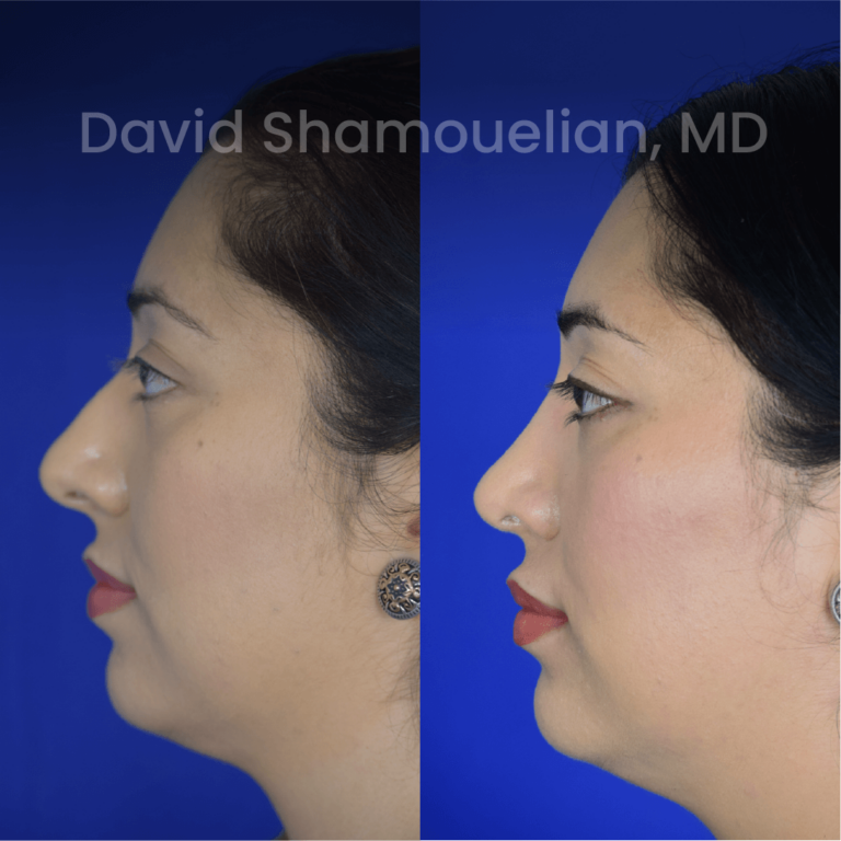 allure-bh-before-after-posts-pt-37-05